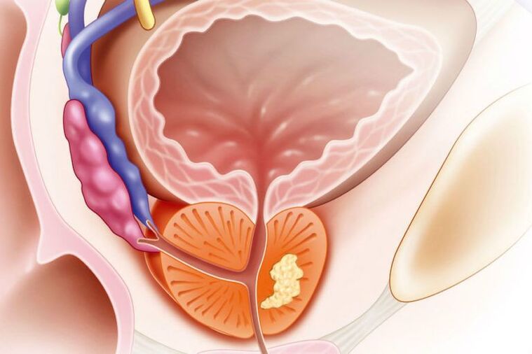 prostate cancer in men