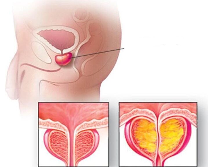 The location of the prostate gland, the prostate is normal and enlarged in chronic prostatitis