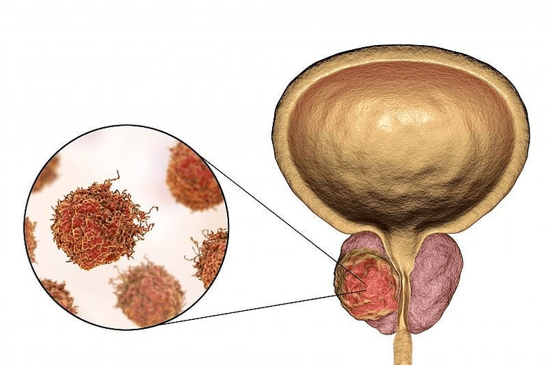 What does prostate damage look like
