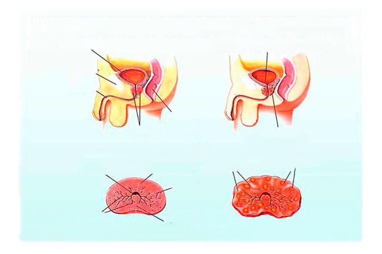 Signs -Chronic prostatitis