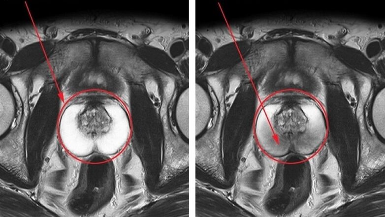 healthy prostate and inflamed with chronic prostatitis