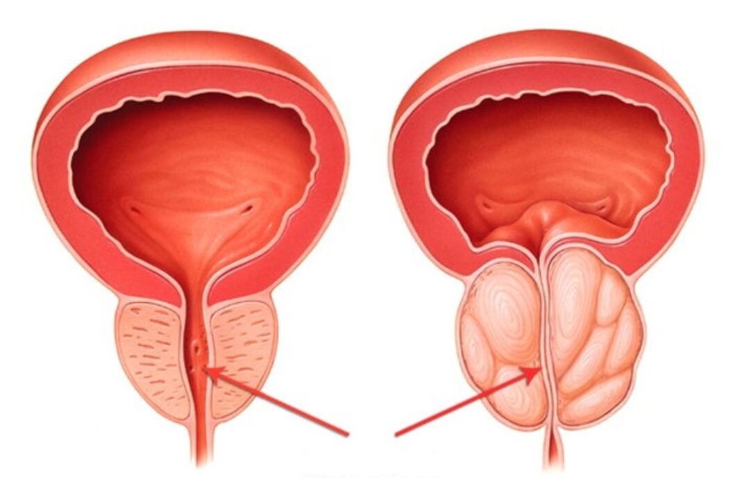 healthy prostate and inflamed with prostatitis