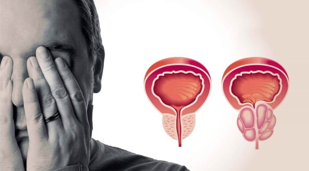 A healthy and inflamed prostate
